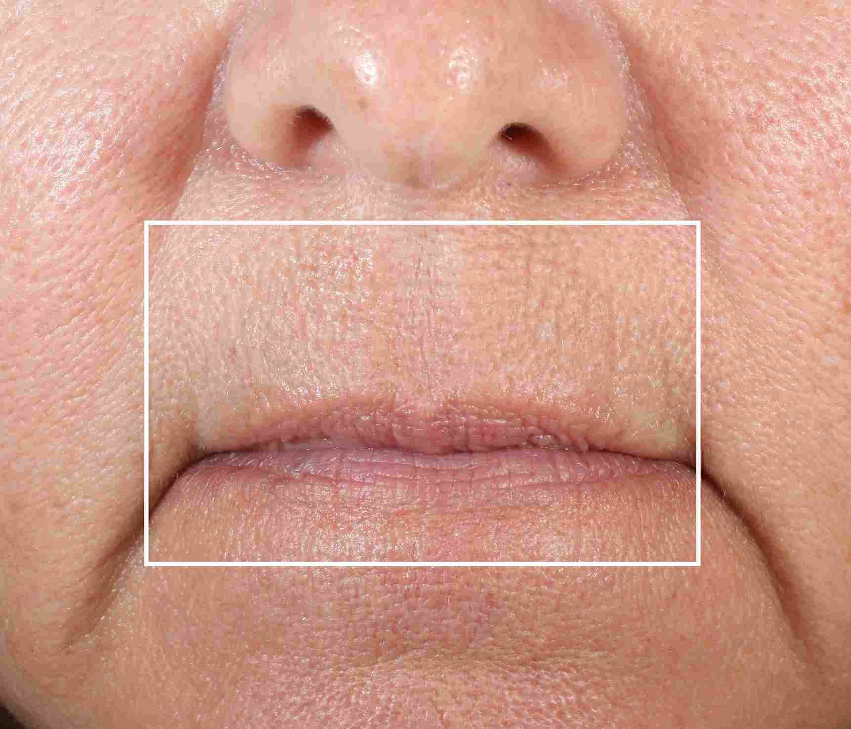 NuFace Fix Line Smoothing Device at Why So