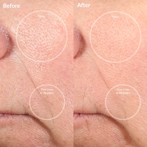PMD Personal Microderm Pro